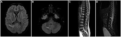 Multiple sclerosis under the age of ten: the challenge of a rare diagnosis in a special population – a case series